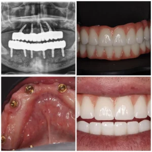 All-on-4 Technique (Advanced Level) all on 4 implants 1